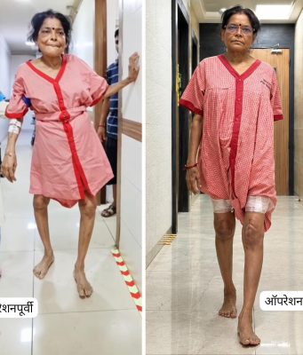 गुडघेदुखीमुळे ३ वर्षांपासून त्रस्त वयस्कर महिलेवर कल्याणच्या आयुष हॉस्पिटलमध्ये यशस्वी रोबोटिक शस्त्रक्रिया